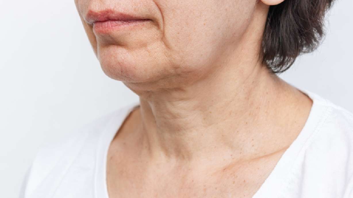 Tighten Sagging Skin Caused by Weight Loss Injections